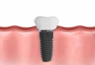 Implant zębowy, most czy proteza – co wybrać?